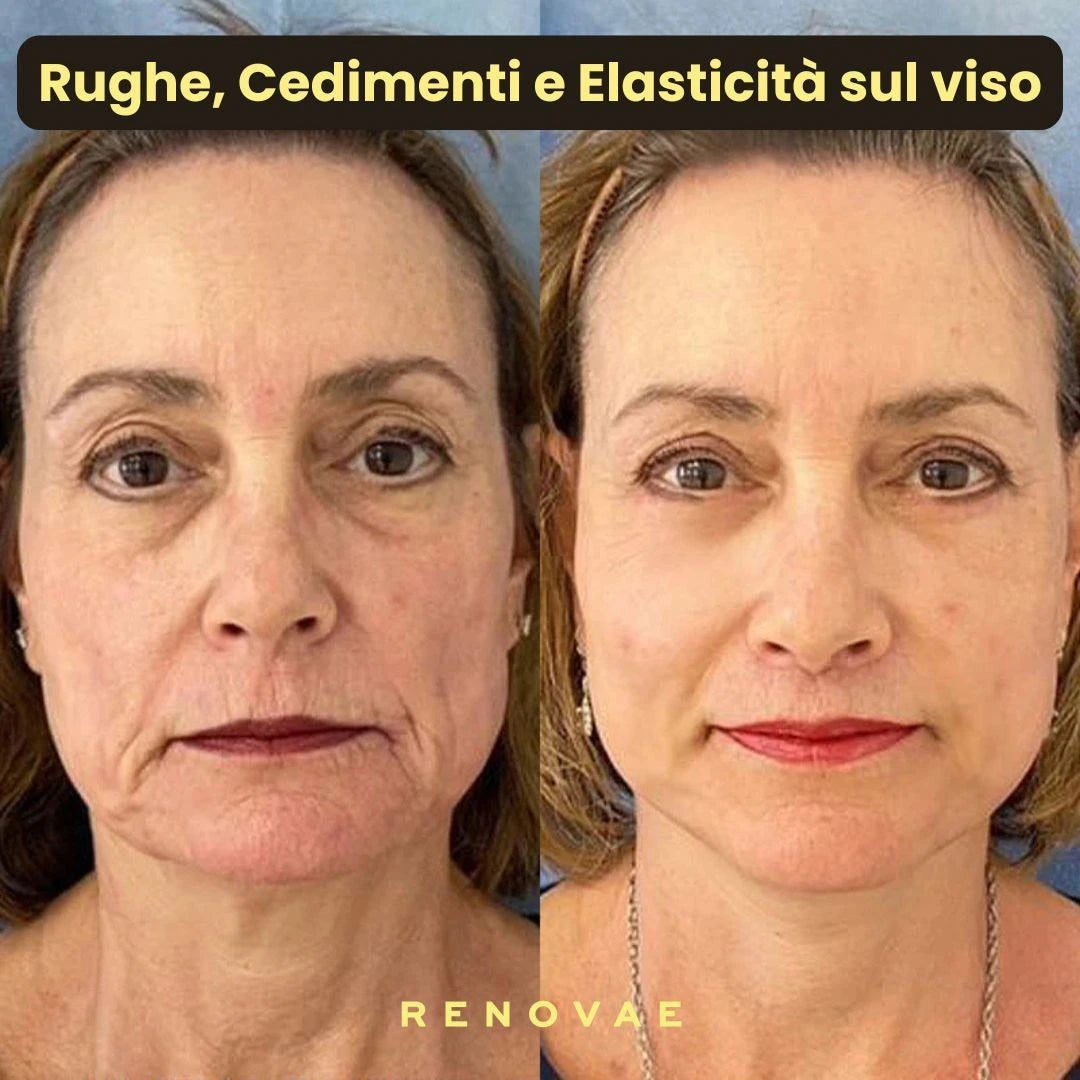 Pack Kit Micro-Infusione