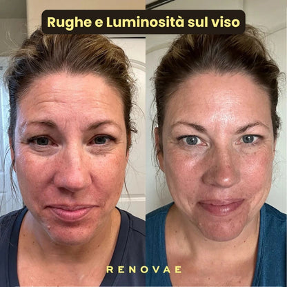 Pack Kit Micro-Infusione