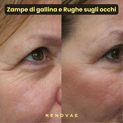 Pack Kit Micro-Infusione